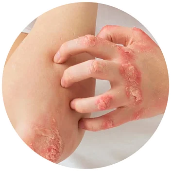 Layer 1 copy - FORU | Malaysia Eczema Skincare and Sensitive Skin Solutions