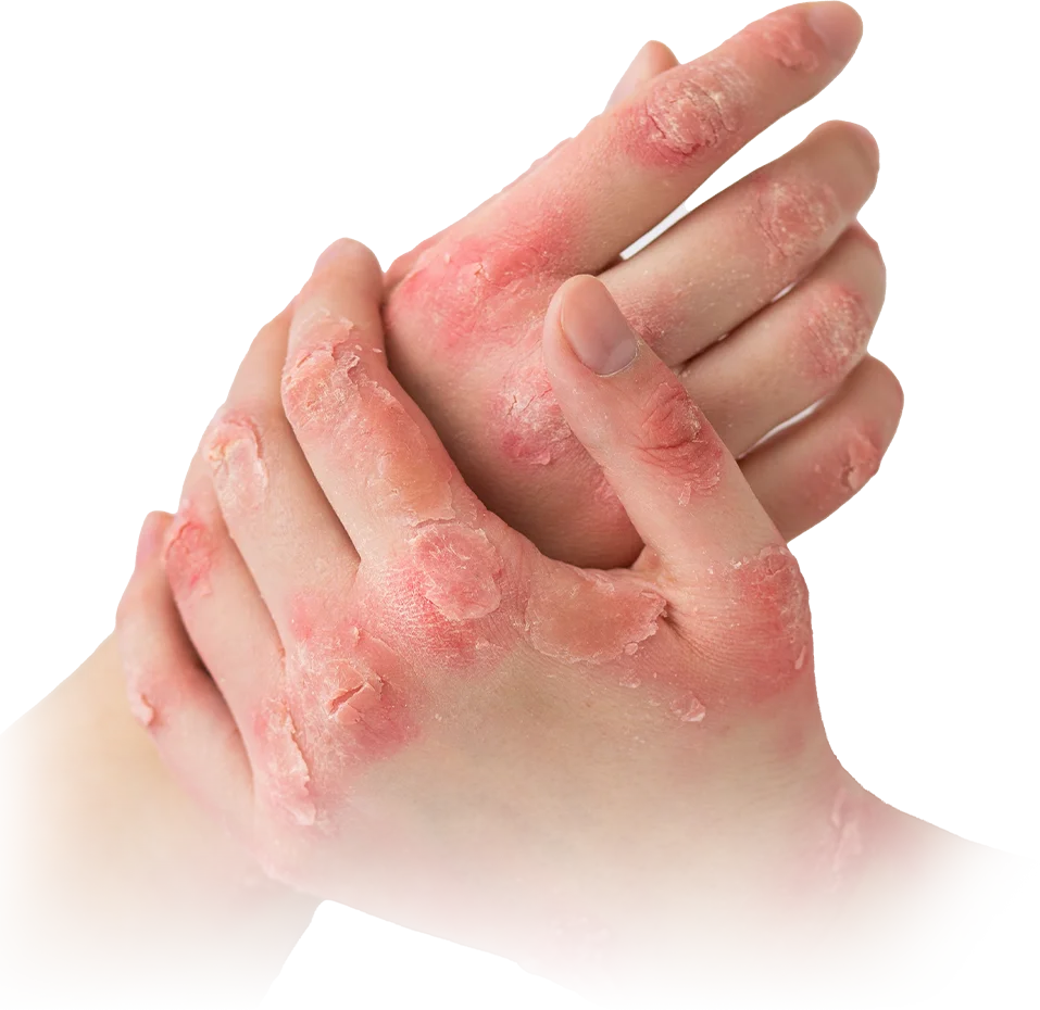 Layer 2 1 - FORU | Malaysia Eczema Skincare and Sensitive Skin Solutions