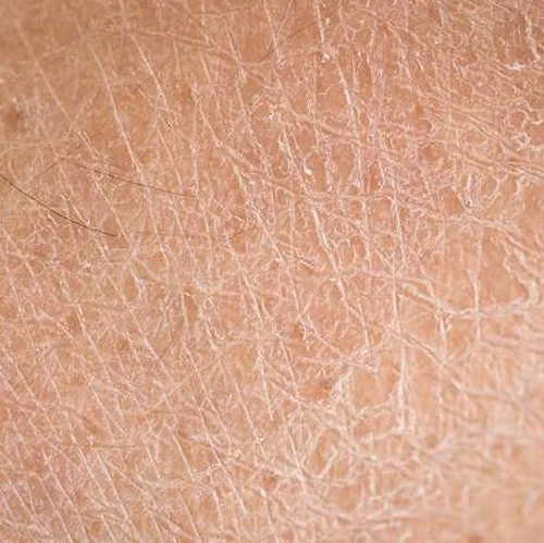 kulit bersisikimg - FORU | Malaysia Eczema Skincare and Sensitive Skin Solutions