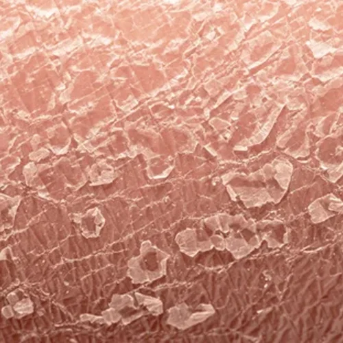 kulit kering dan merekahimg - FORU | Malaysia Eczema Skincare and Sensitive Skin Solutions
