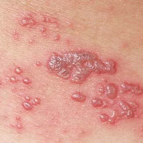 lepuh keluar airimg - FORU | Malaysia Eczema Skincare and Sensitive Skin Solutions