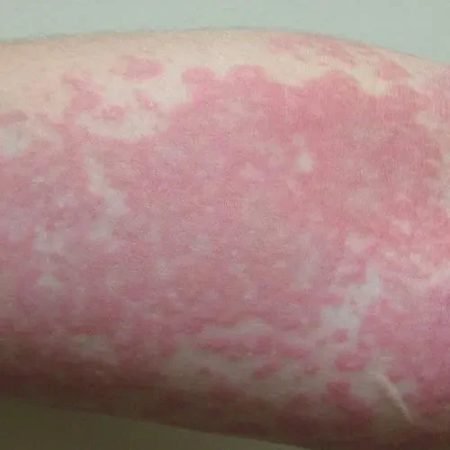 merah dradangimg - FORU | Malaysia Eczema Skincare and Sensitive Skin Solutions
